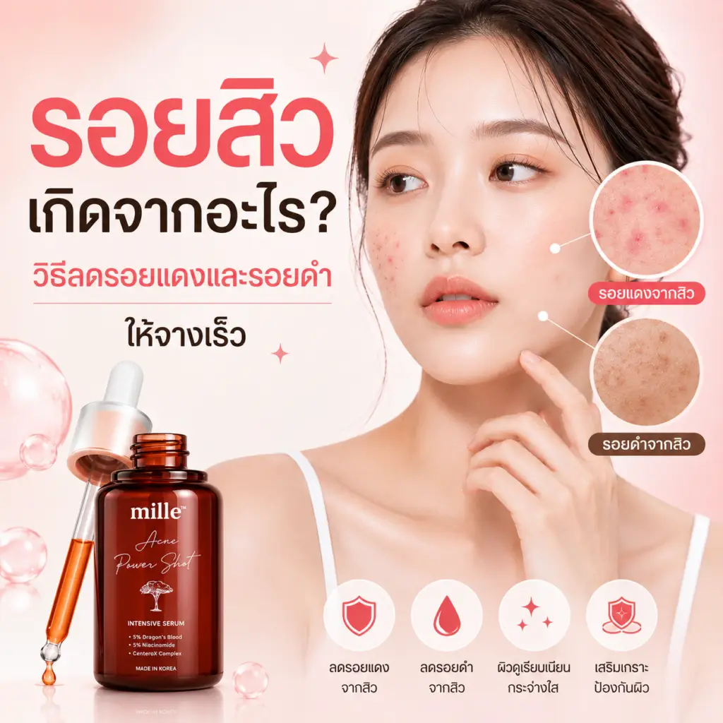 รอยสิวเกิดจากอะไร? วิธีลดรอยแดงและรอยดำจากสิวให้จางเร็ว