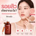 รอยสิวเกิดจากอะไร? วิธีลดรอยแดงและรอยดำจากสิวให้จางเร็ว
